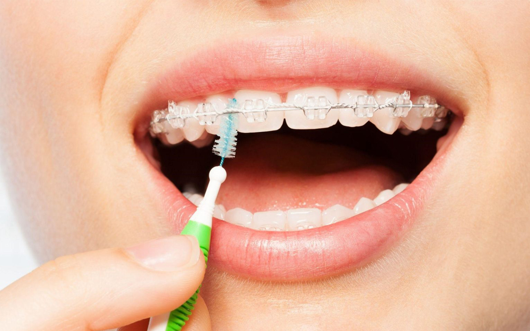 كيفية العناية بصحة أسنانك بعد تبييض الأسنان أو التركيبات التجميلية