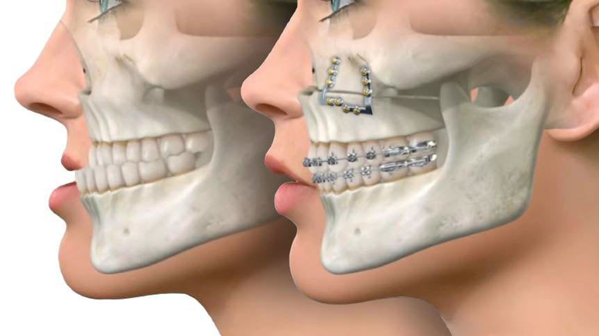 من يحتاج إلى تقويم الأسنان الجراحي؟